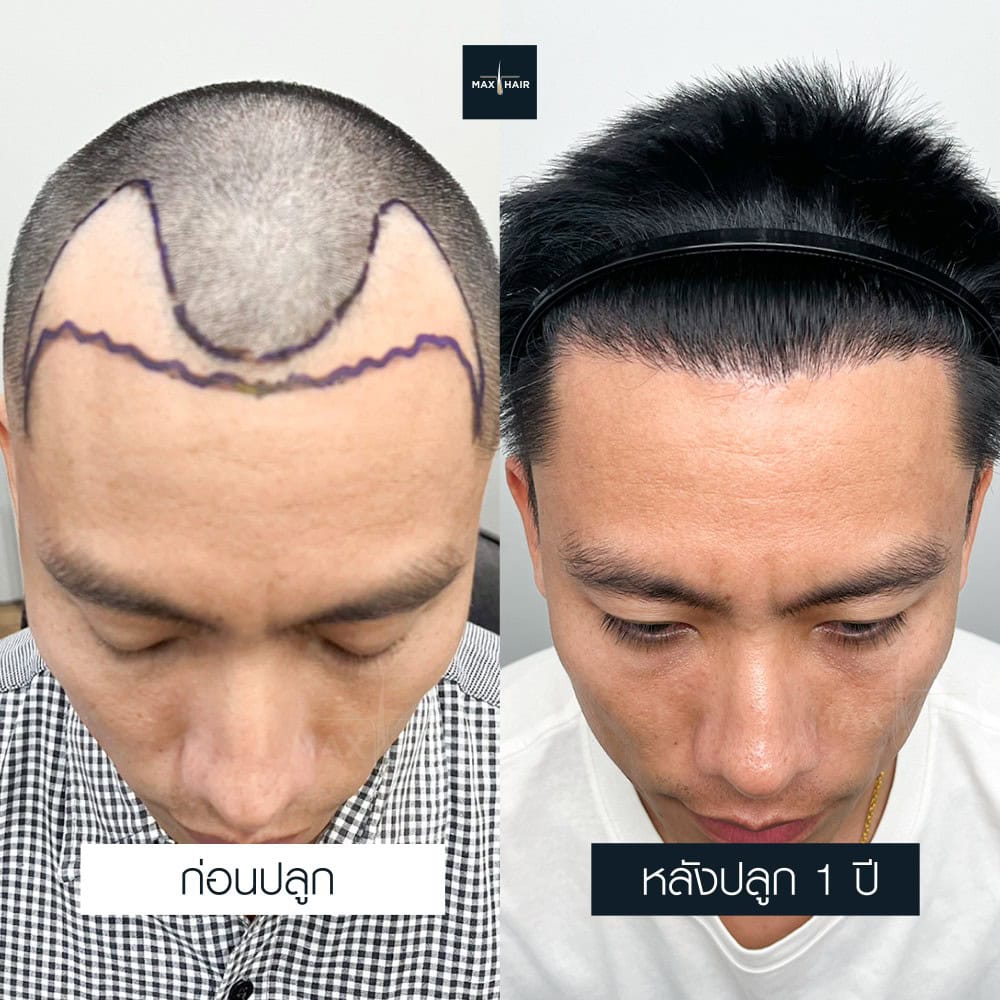 ปลูกผม FUE 2200 กราฟ คุณสัมฤทธิ์ เพ็งพิน - Max Hair (2)