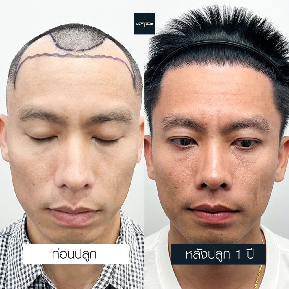 ปลูกผม FUE 2200 กราฟ คุณสัมฤทธิ์ เพ็งพิน - Max Hair (1)