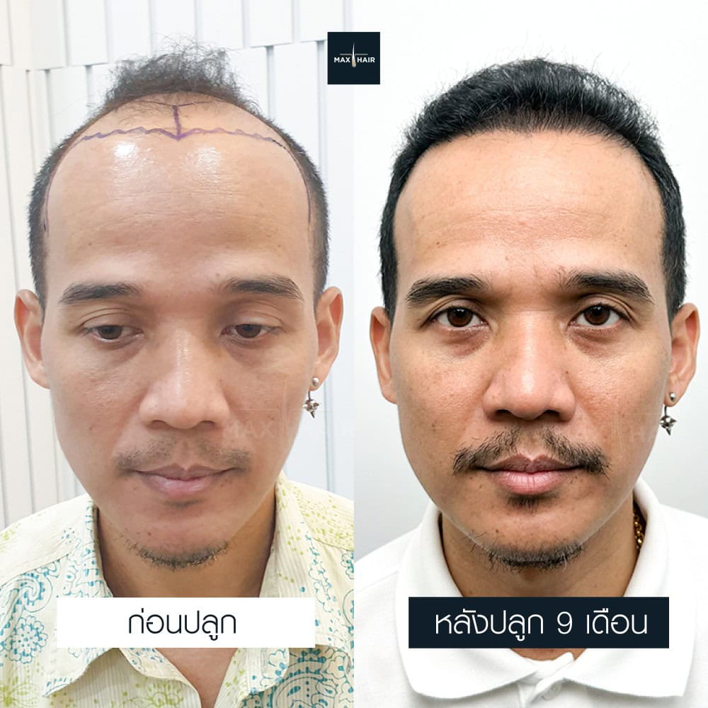 ปลูกผม MCG 3500 กราฟ คุณสามิตร มาตะรักษ์ - Max Hair (1)