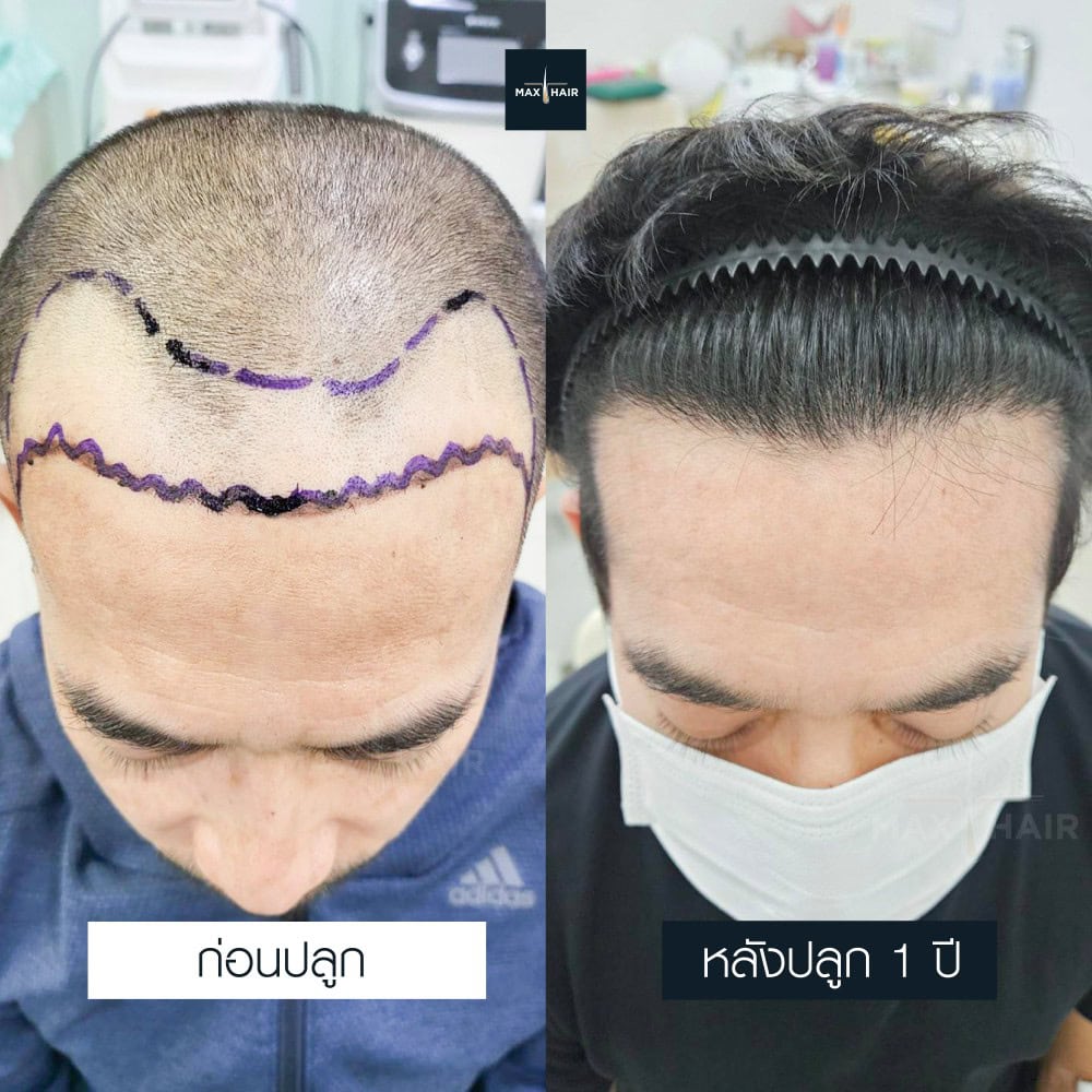 ปลูกผม MCG 3200 กราฟ คุณอนันตชัย อนันตพิพัฒนกูล - Max Hair (1)