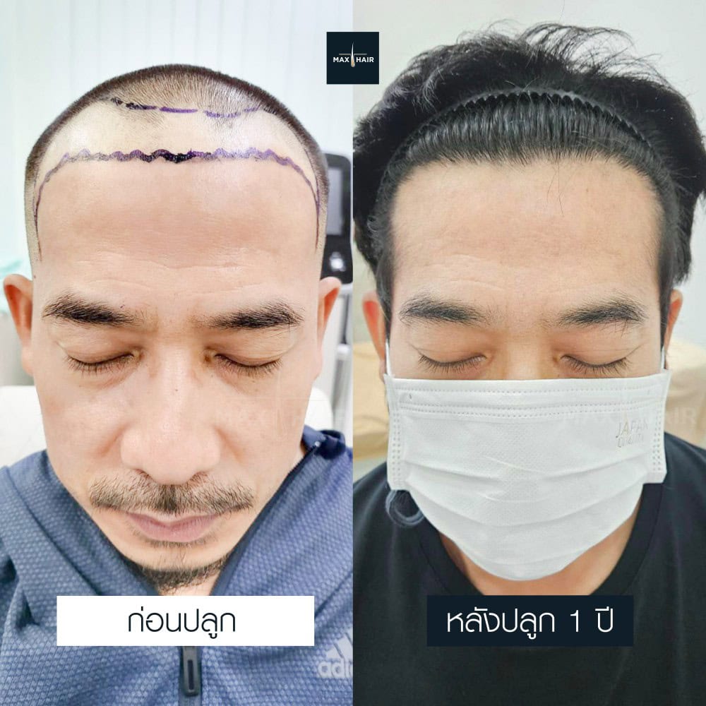 ปลูกผม MCG 3200 กราฟ คุณอนันตชัย อนันตพิพัฒนกูล - Max Hair (2)