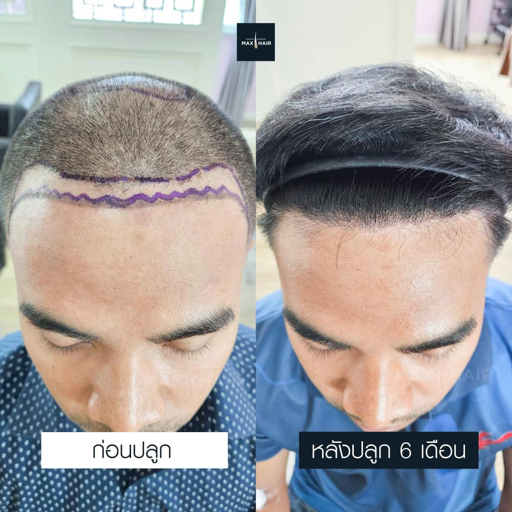 ปลูกผม MCG 2750 กราฟ คุณอภิสิทธิ์ ตรีแก้วสุราษฐ์ธานี - Max Hair