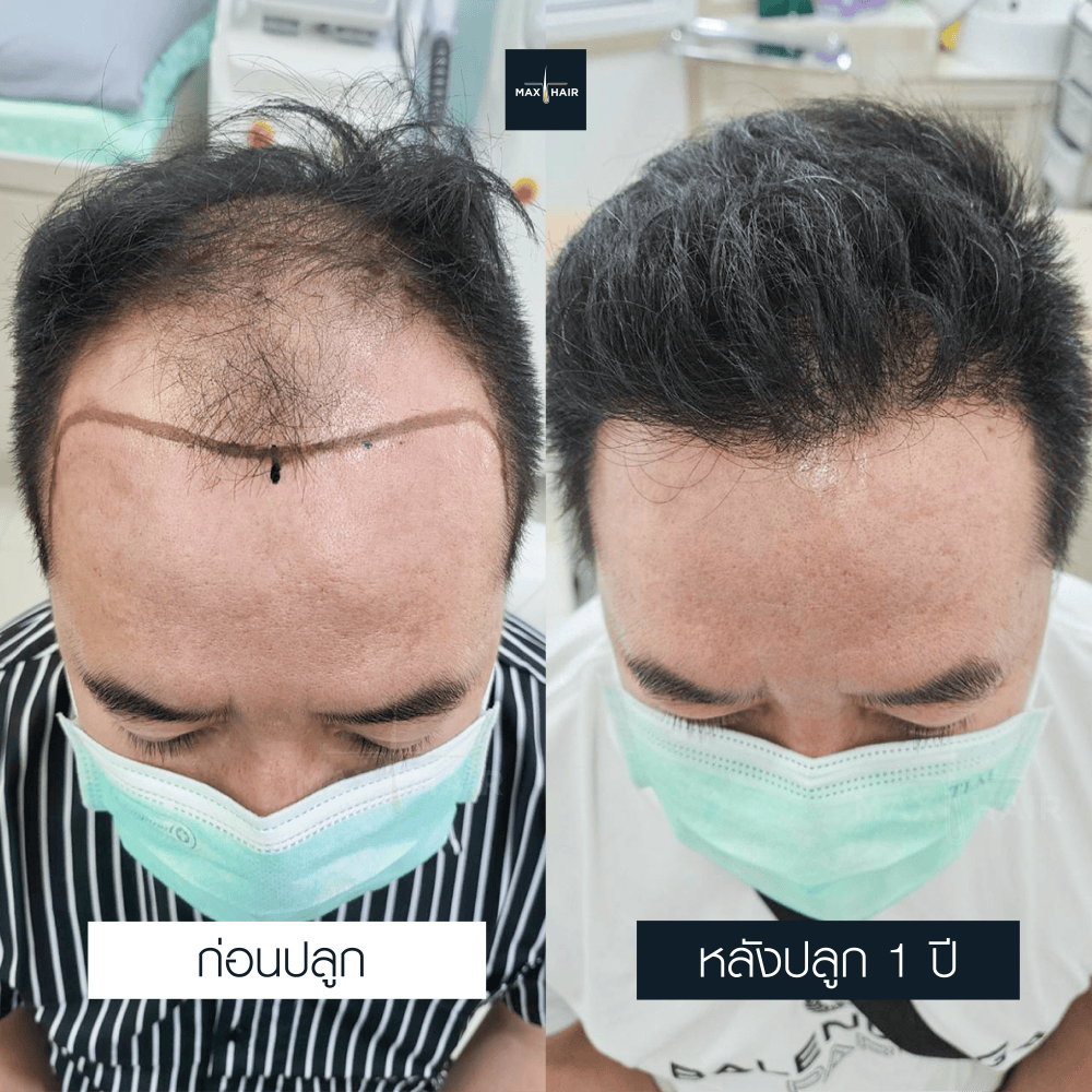 ปลูกผม FUE 3300 กราฟ คุณสุลิยง พมมา - Max Hair (1)