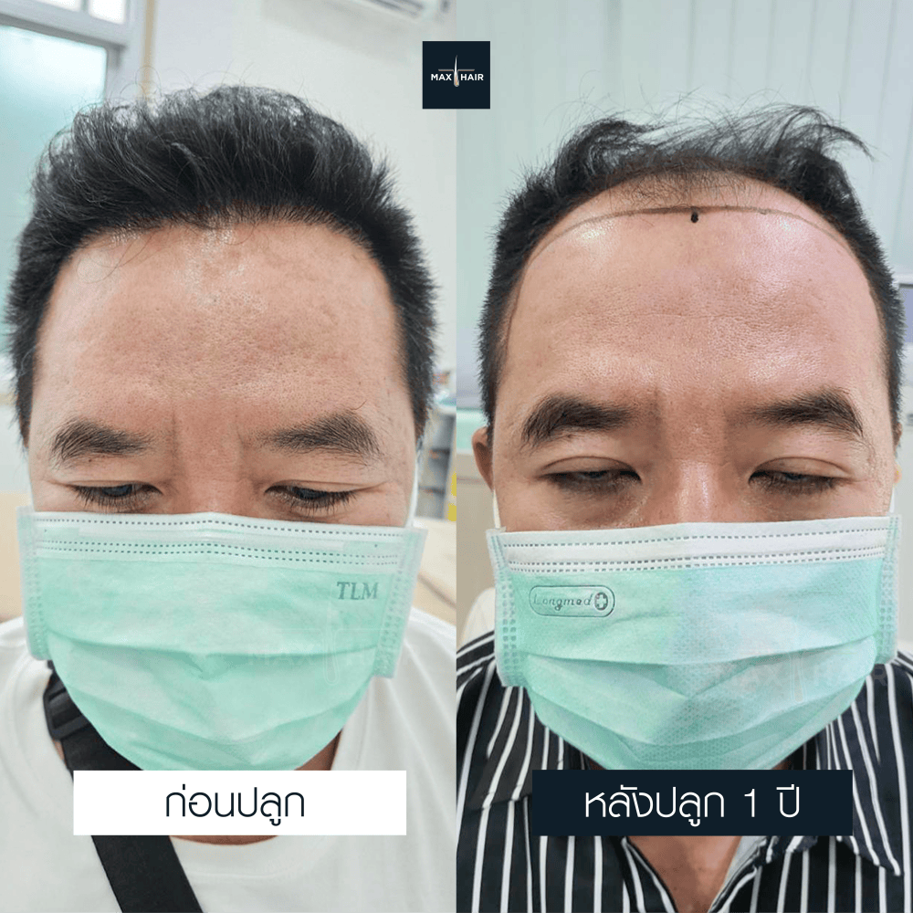 ปลูกผม FUE 3300 กราฟ คุณสุลิยง พมมา - Max Hair (2)