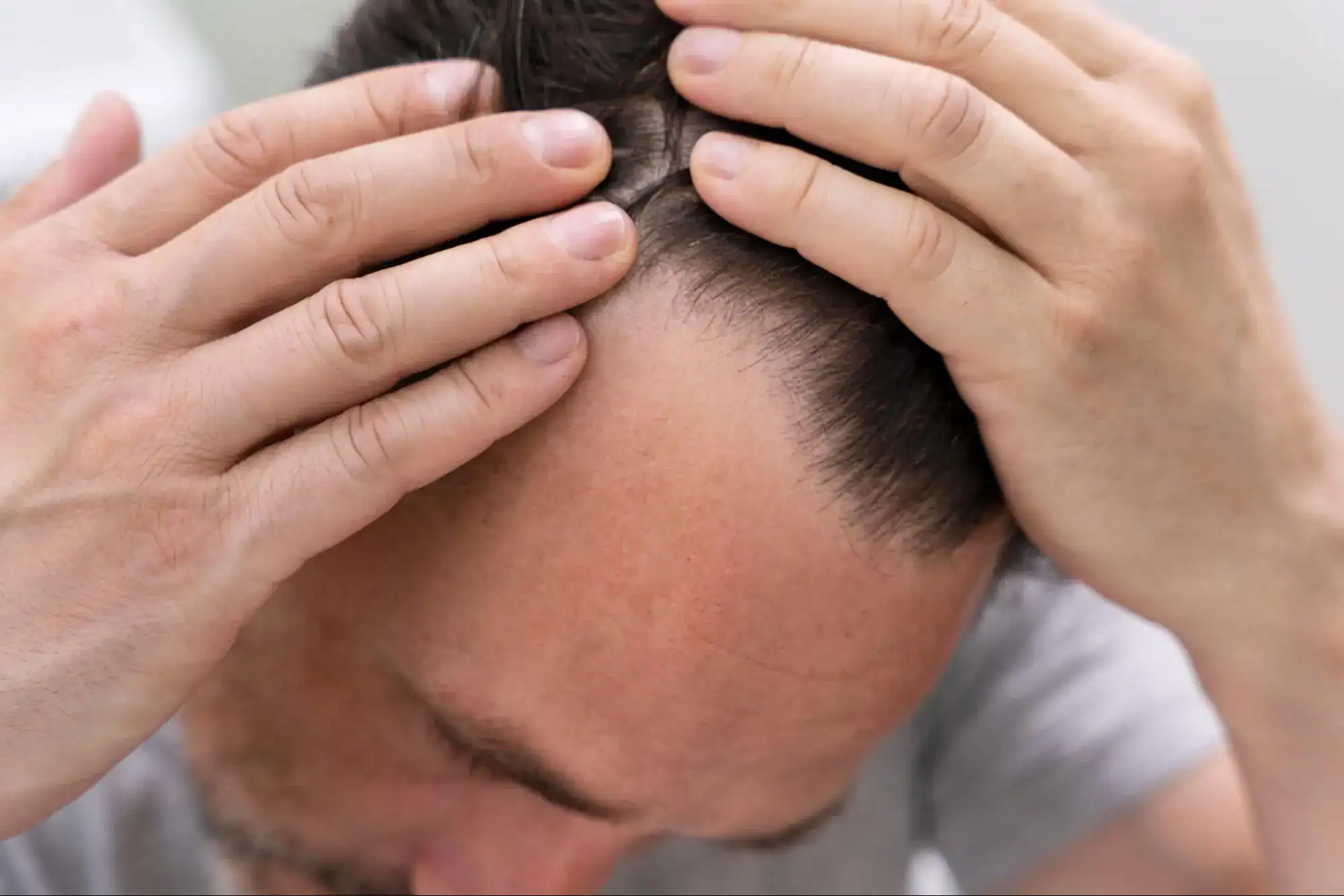 Hair Transplant Cost Factors
