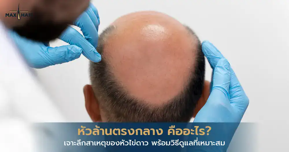 หัวล้านตรงกลาง สาเหตุอาการ