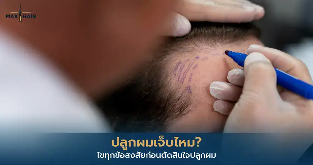 ปลูกผมเจ็บไหม