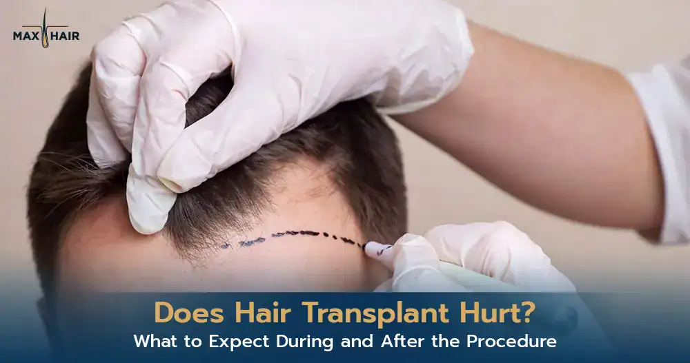 Does Hair Transplant Hurt