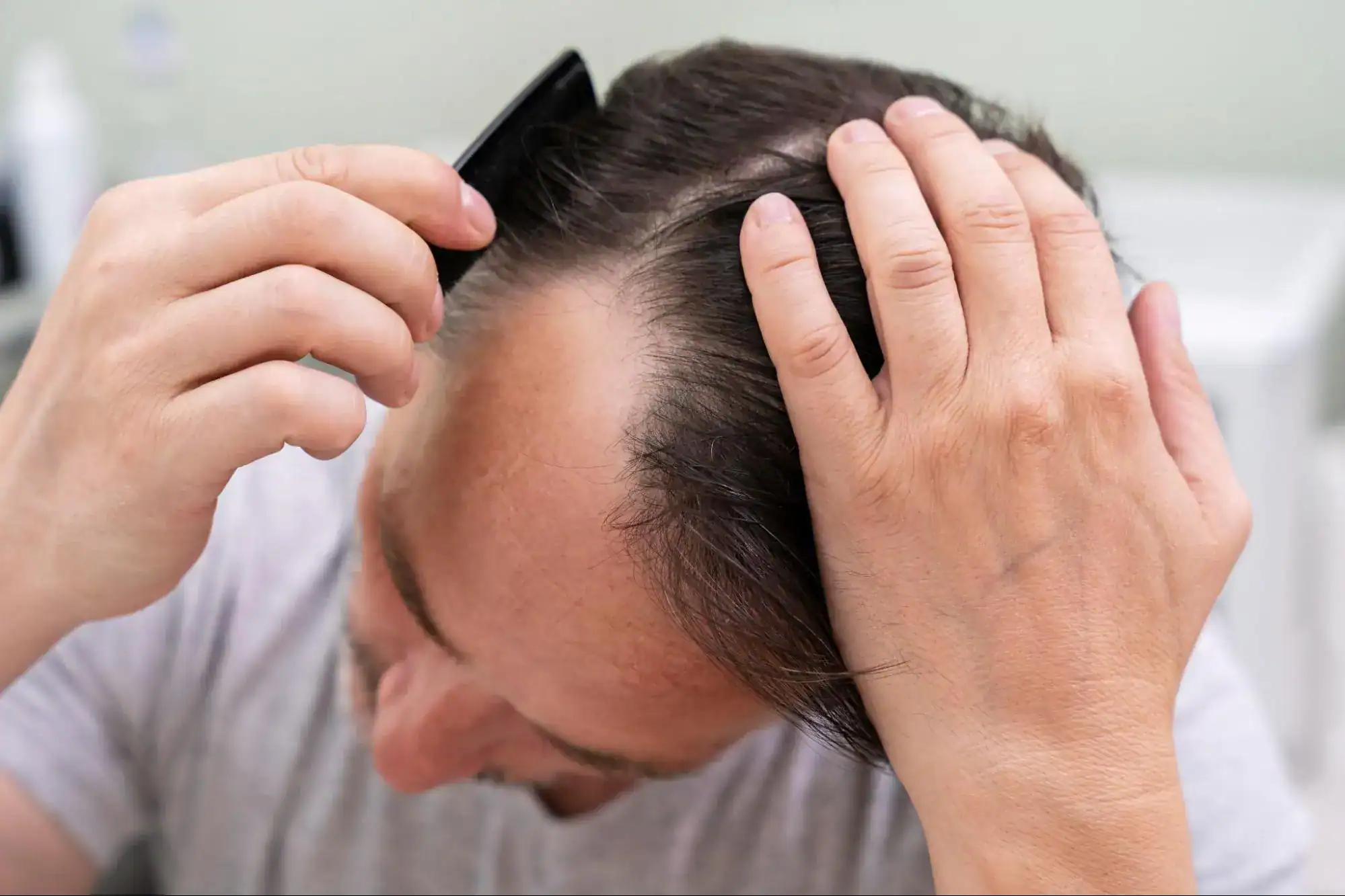How to care crown balding