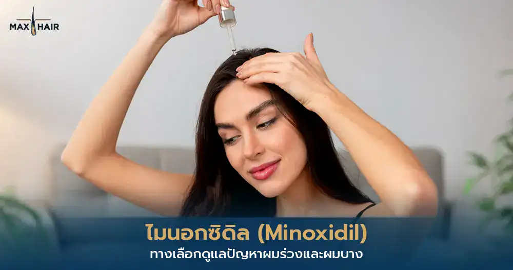 ไมนอกซิดิล