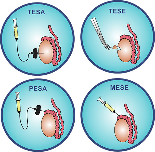 Illustration of TESA, TESE, PESA, and MESA procedures for male fertility.