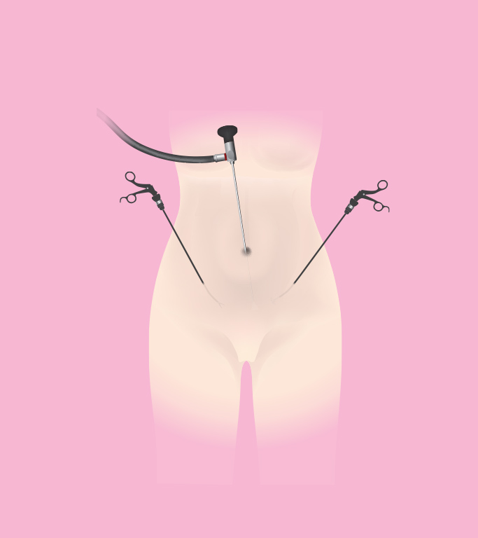 Medical instruments for laparoscopy and hysteroscopy in a surgical setting.