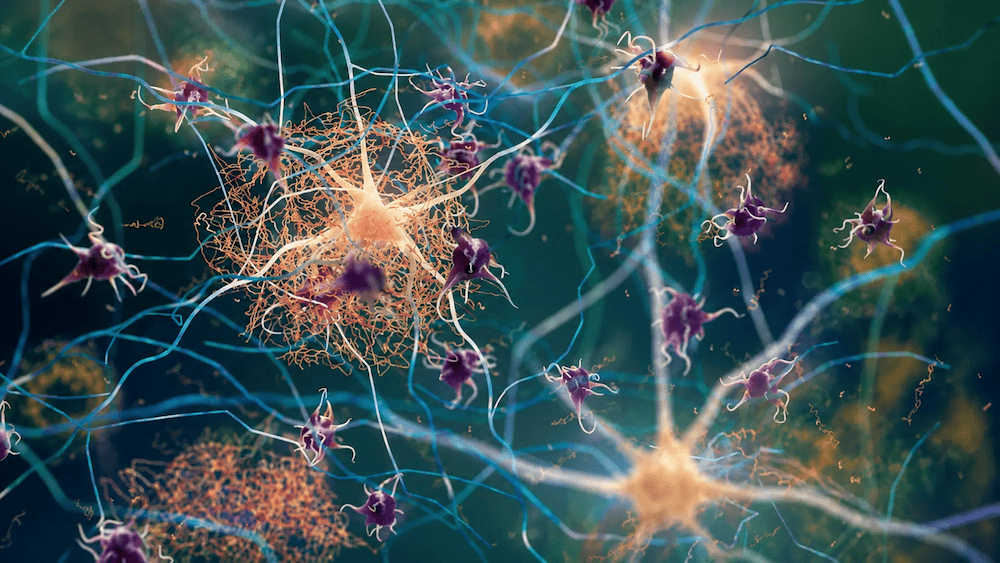 Amyloid and tau: what we know about how Alzheimer’s disease develops