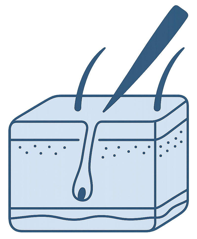 Hair graft illustration