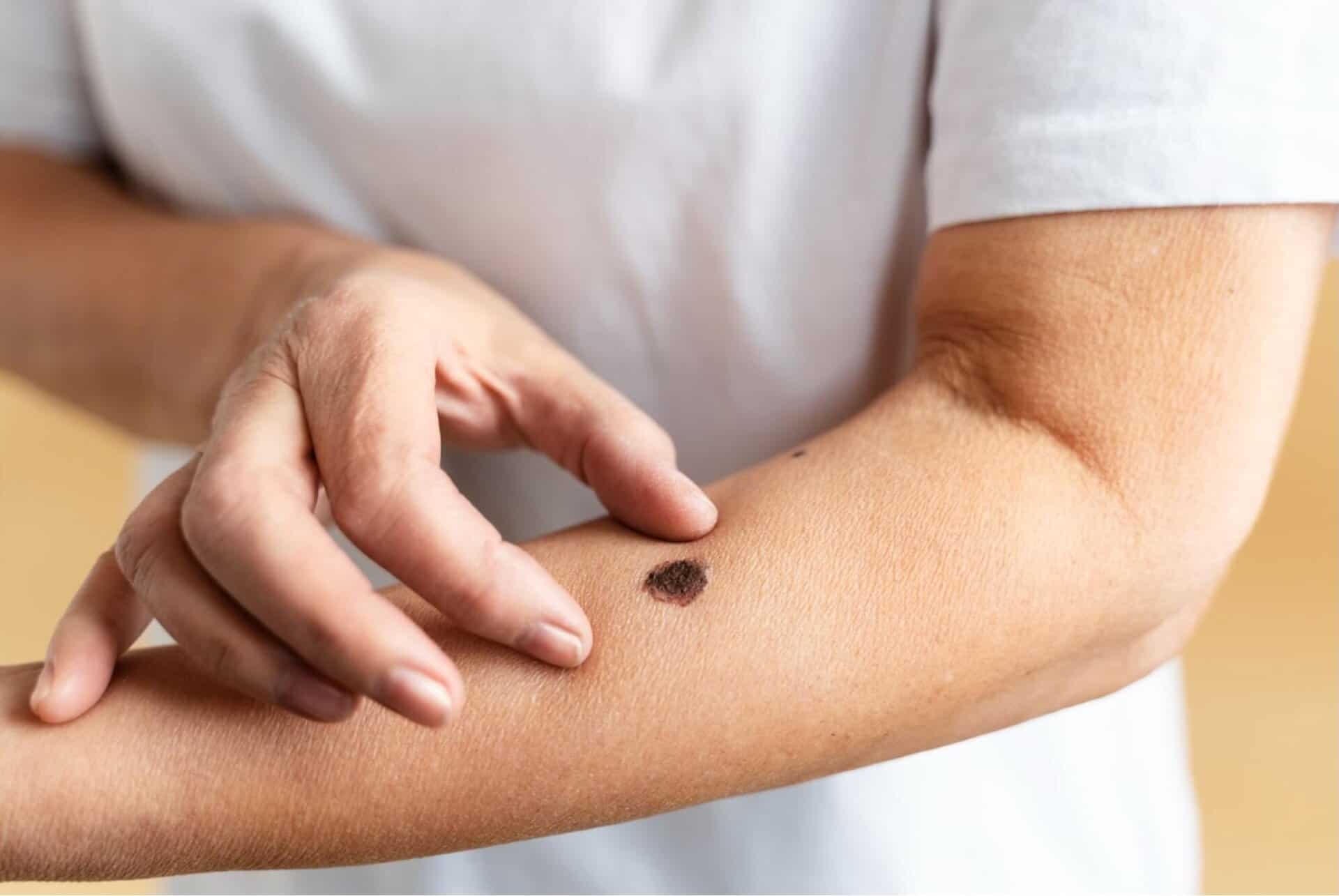 seborrheic keratosis