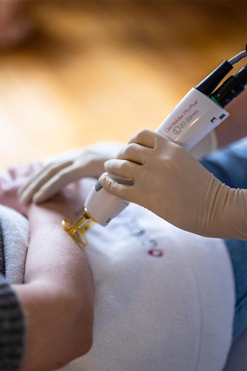Laser Hair Removal