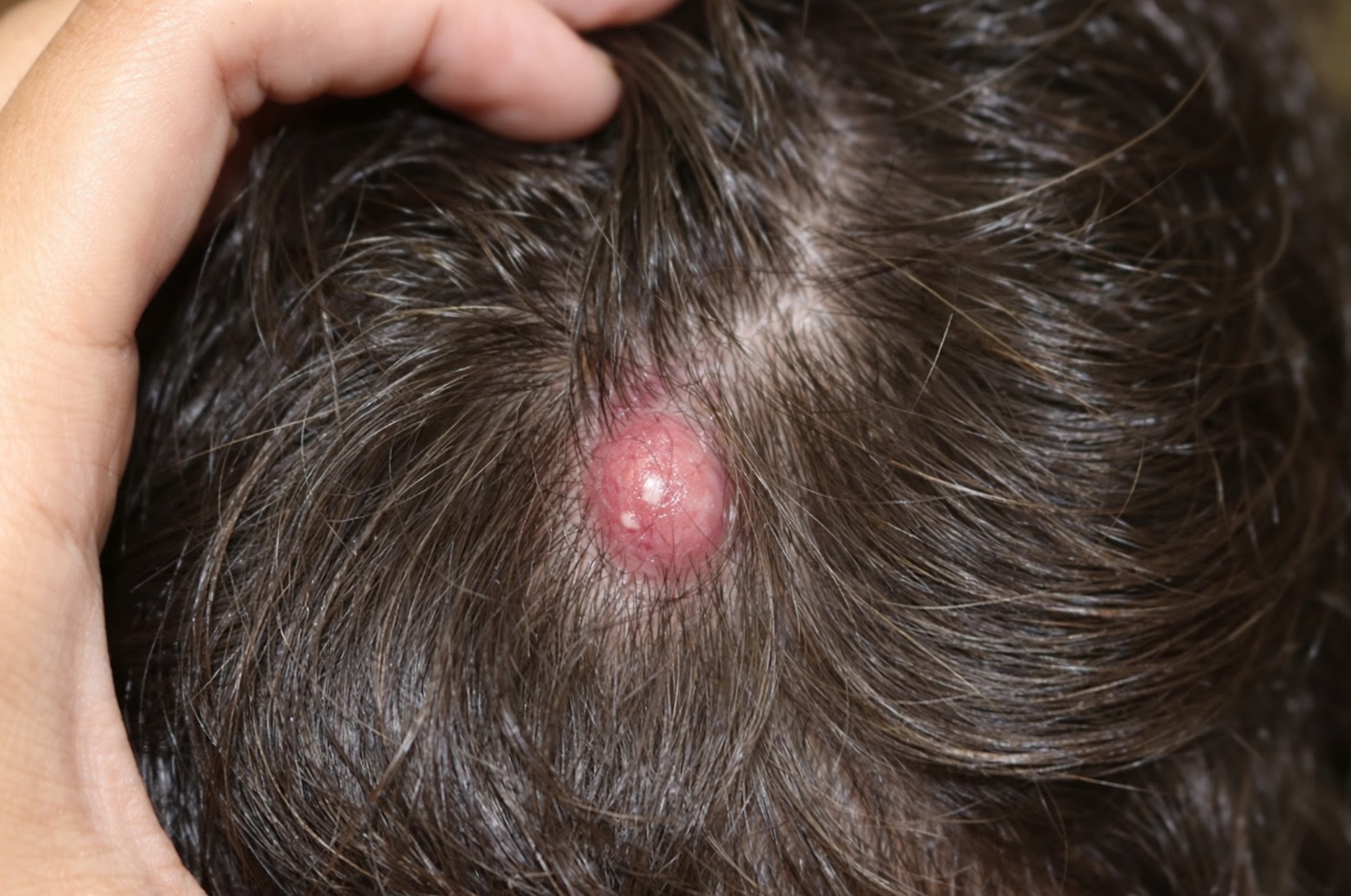 bump on head