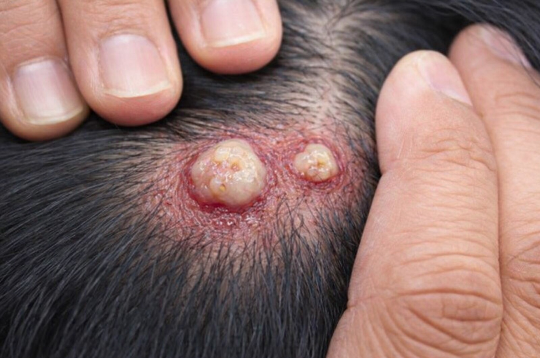 scalp cysts