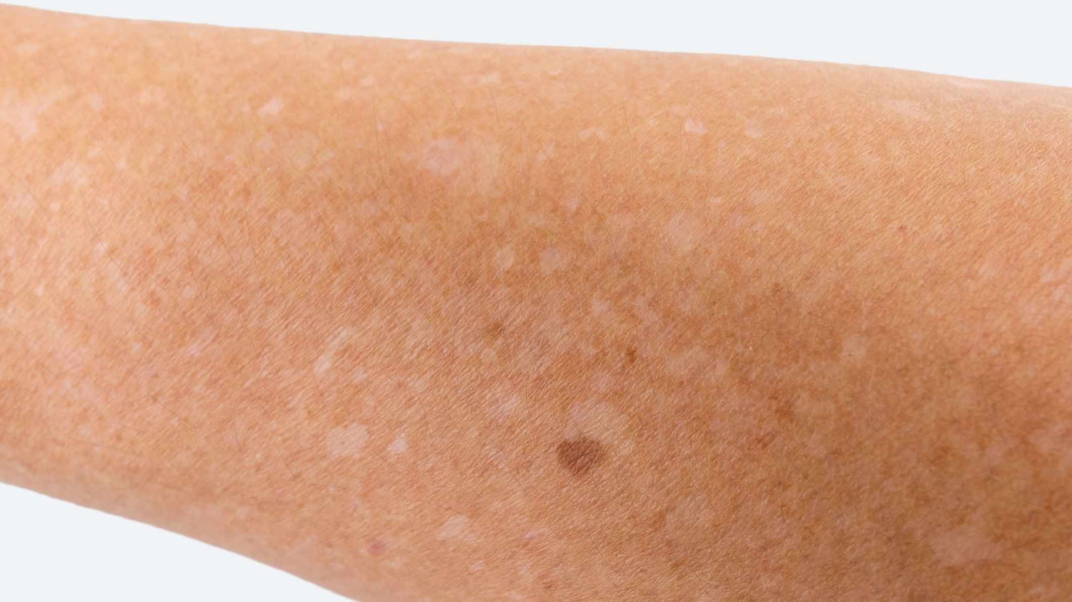 arms with Idiopathic guttate hypomelanosis