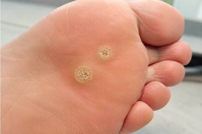 Signs your verucca is healing