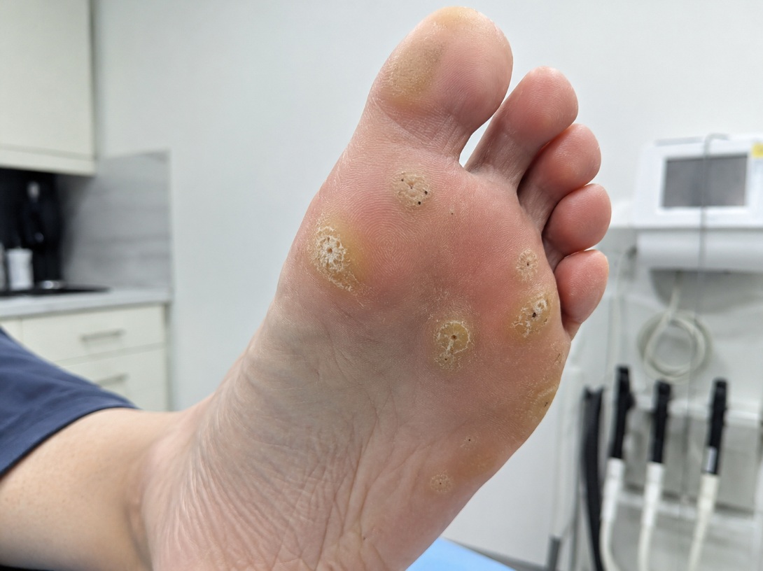 Verruca Healing Stages