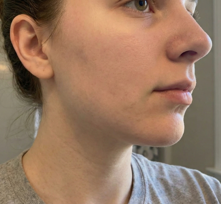 acne after