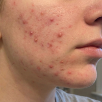 acne on the face