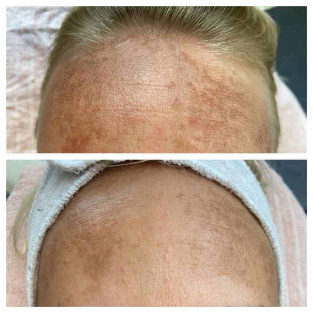 før og efter microneedling behandling
