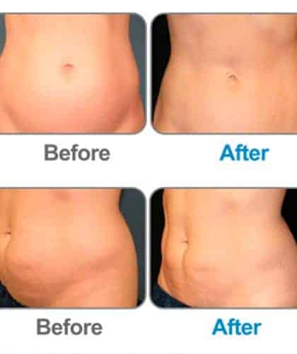 før efter billede af fedtfrysning behandling i Bellissimo Hudplejeklinik