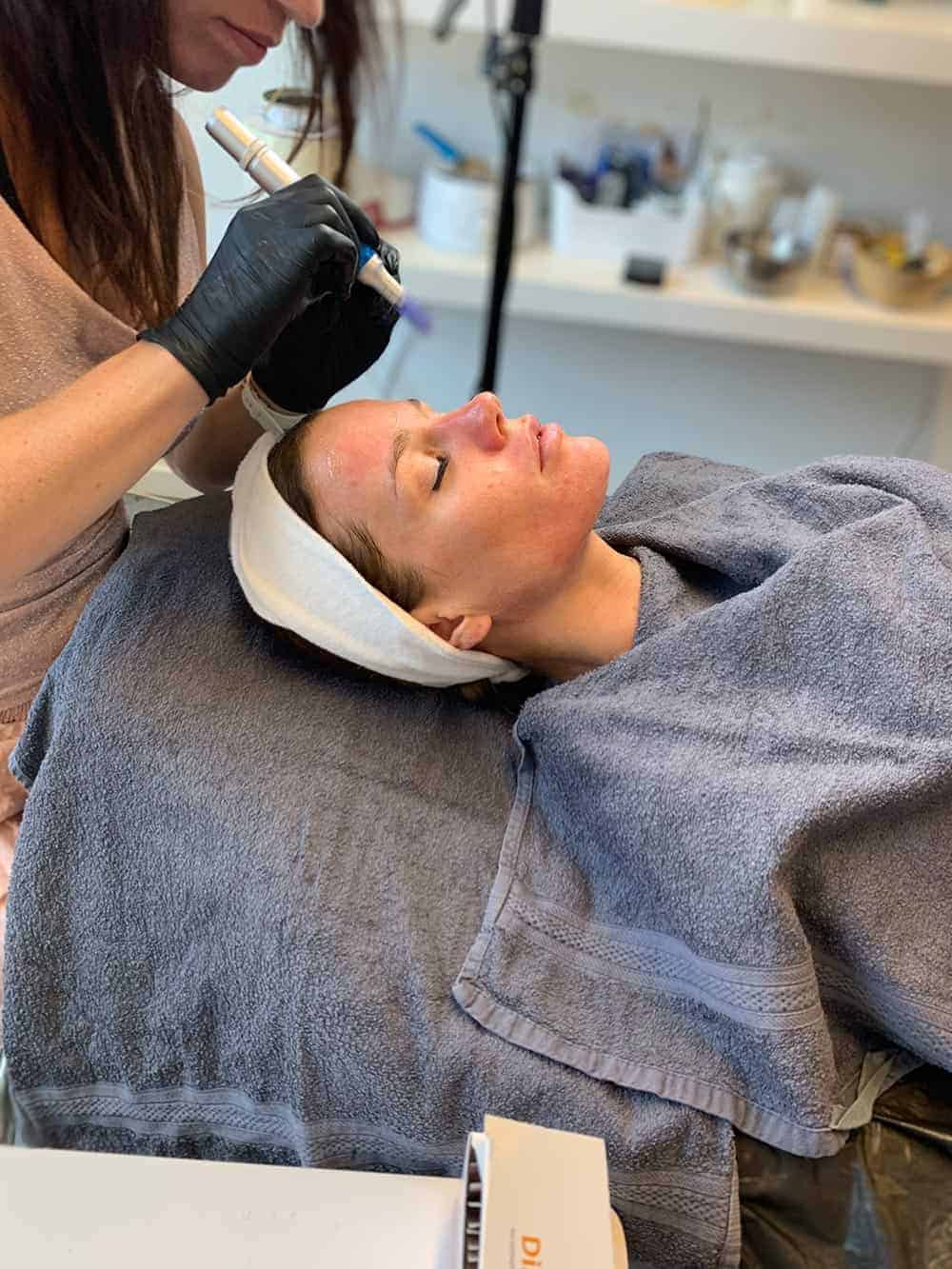 microneedling i Bellissimo Hudplejeklinik