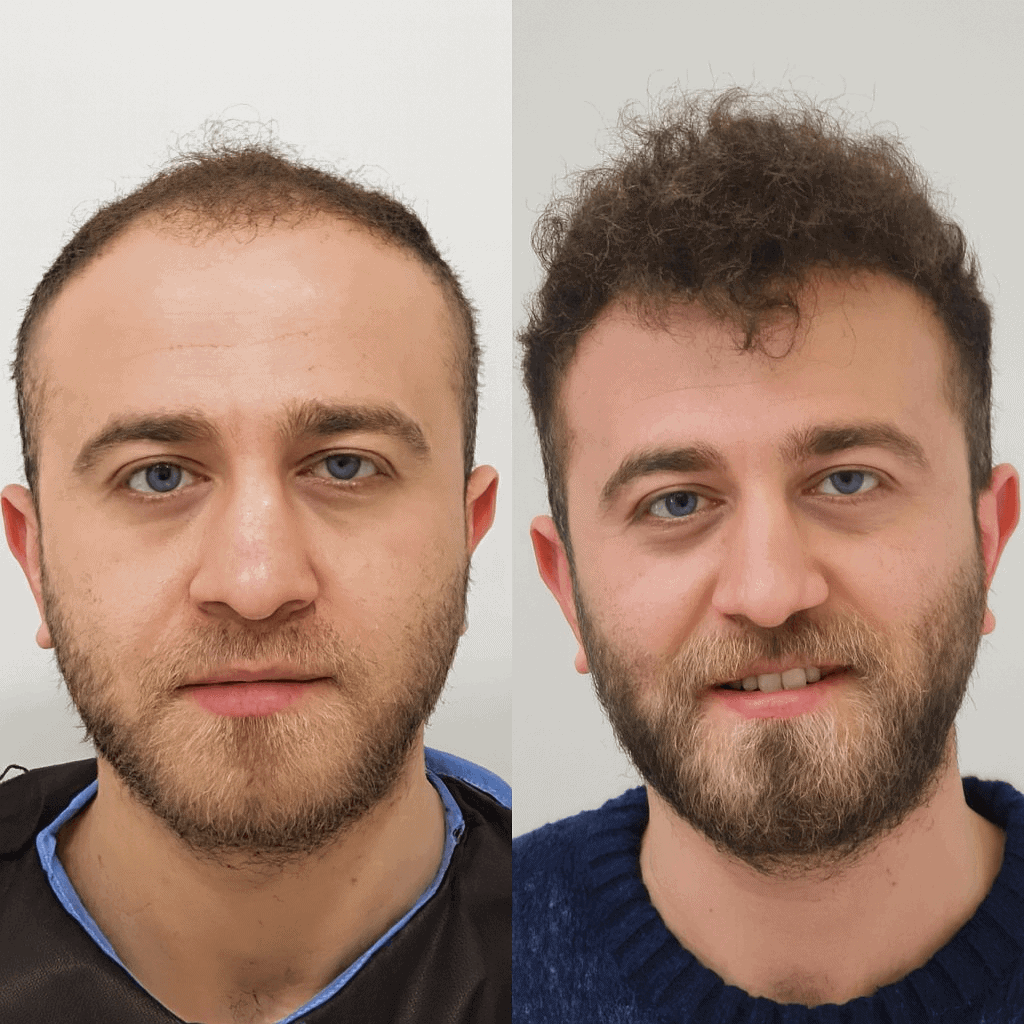 Risultato trapianto capelli prima e dopo Istanbul: testimonianza di Michel, 54 anni, presso una clinica specializzata in Turchia