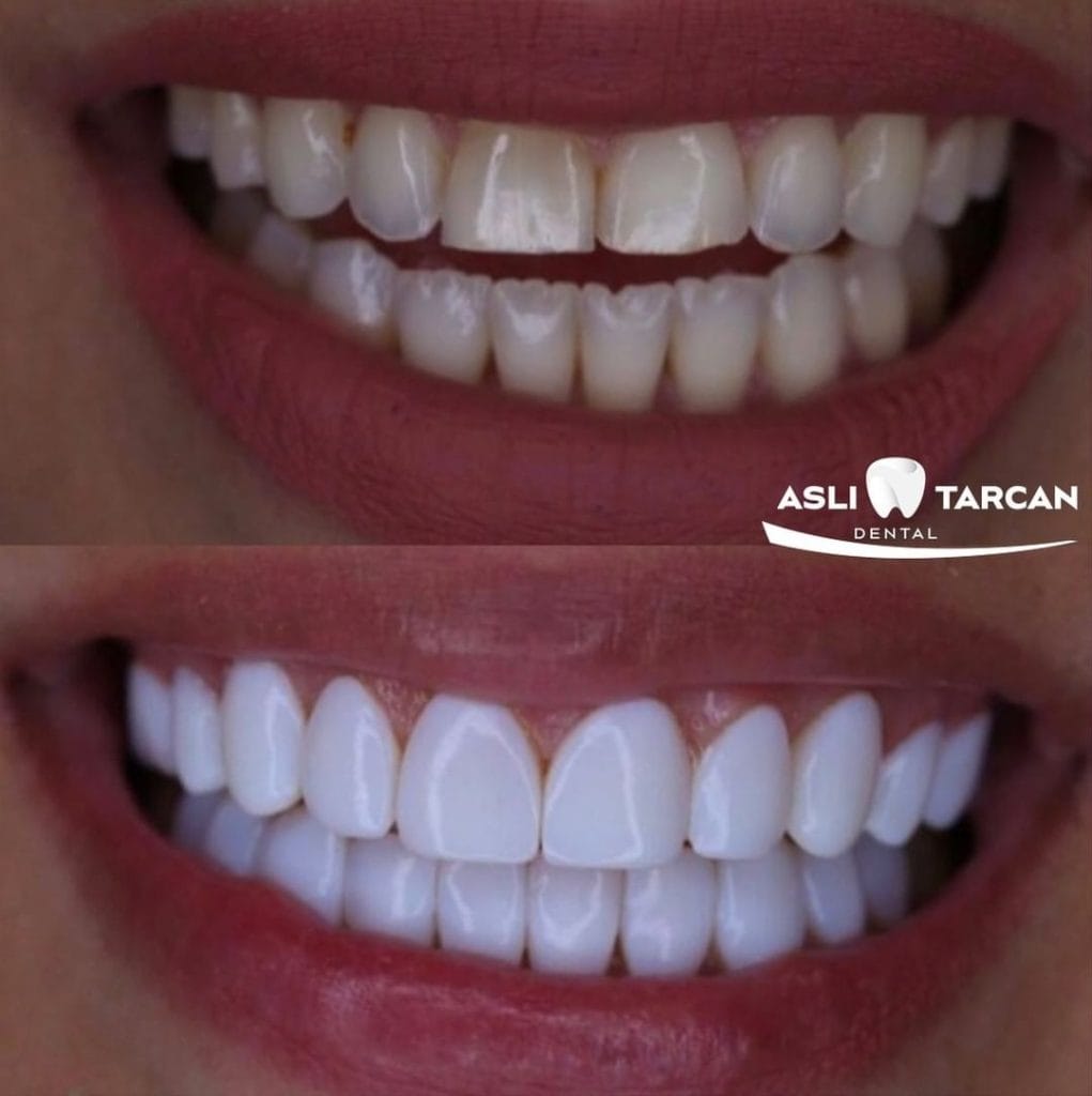 Avant et après pose de facettes dentaires à la clinique Aslı Tarcan en Turquie
