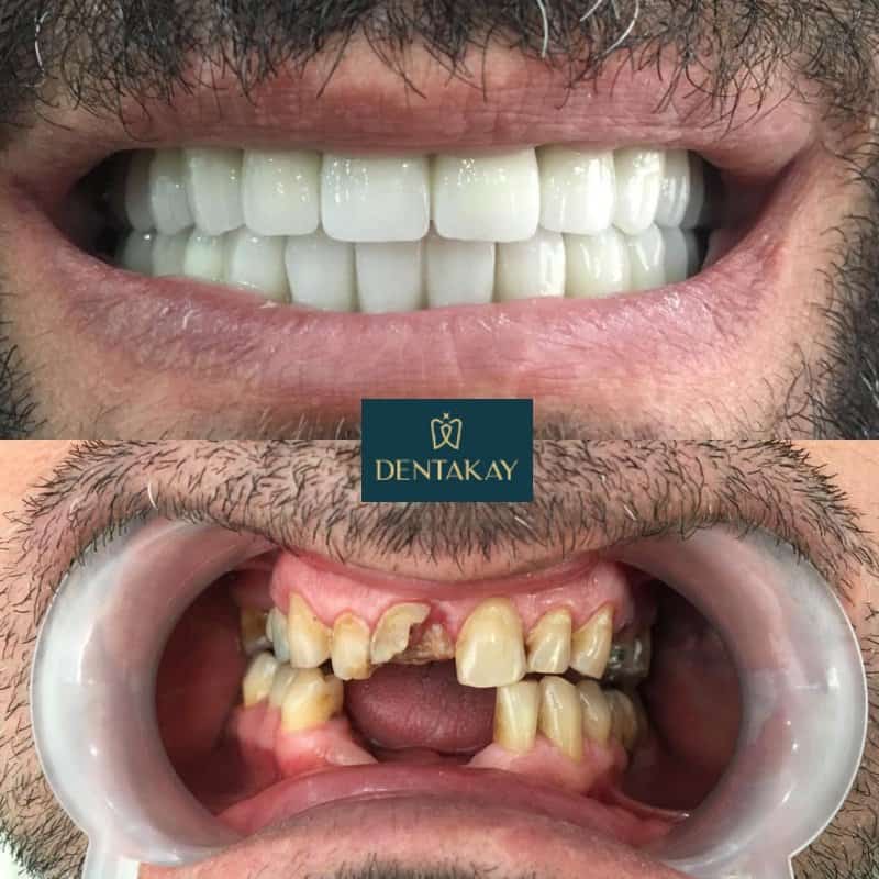 Confronto prima e dopo di una riabilitazione estetica con corone in zirconia e CAD/CAM