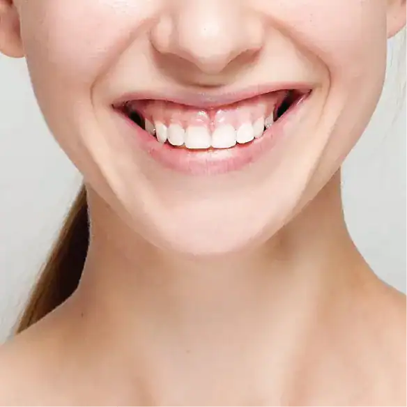 Sorriso perfetto con gengive sane dopo innesto gengivale e rigenerazione ossea