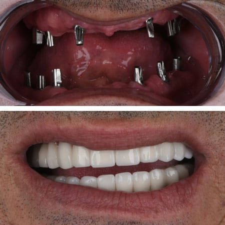 Dettaglio chirurgico di impianti dentali All-on-6 per il ripristino dell'arcata dentale