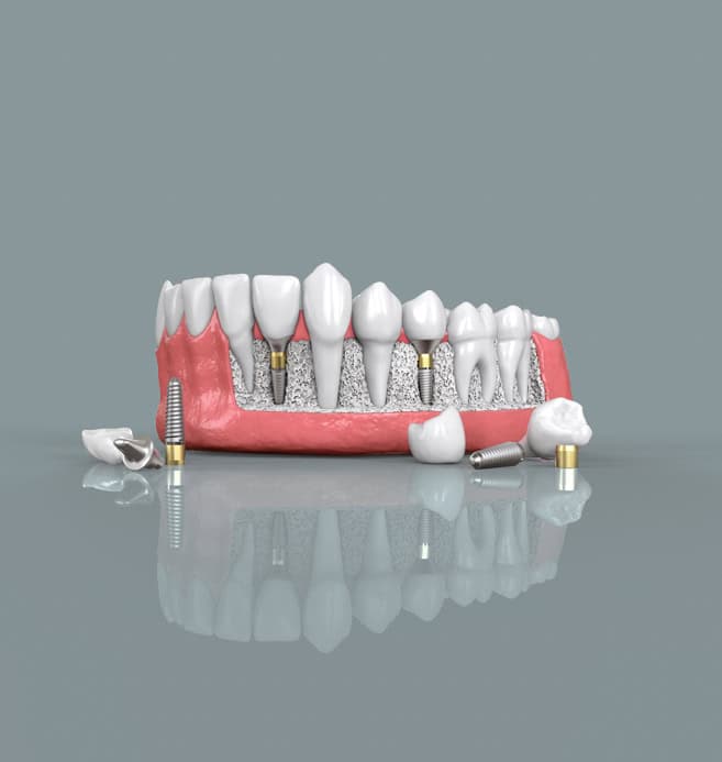 Modello 3D di una protesi dentale su misura realizzata con tecnologia digitale