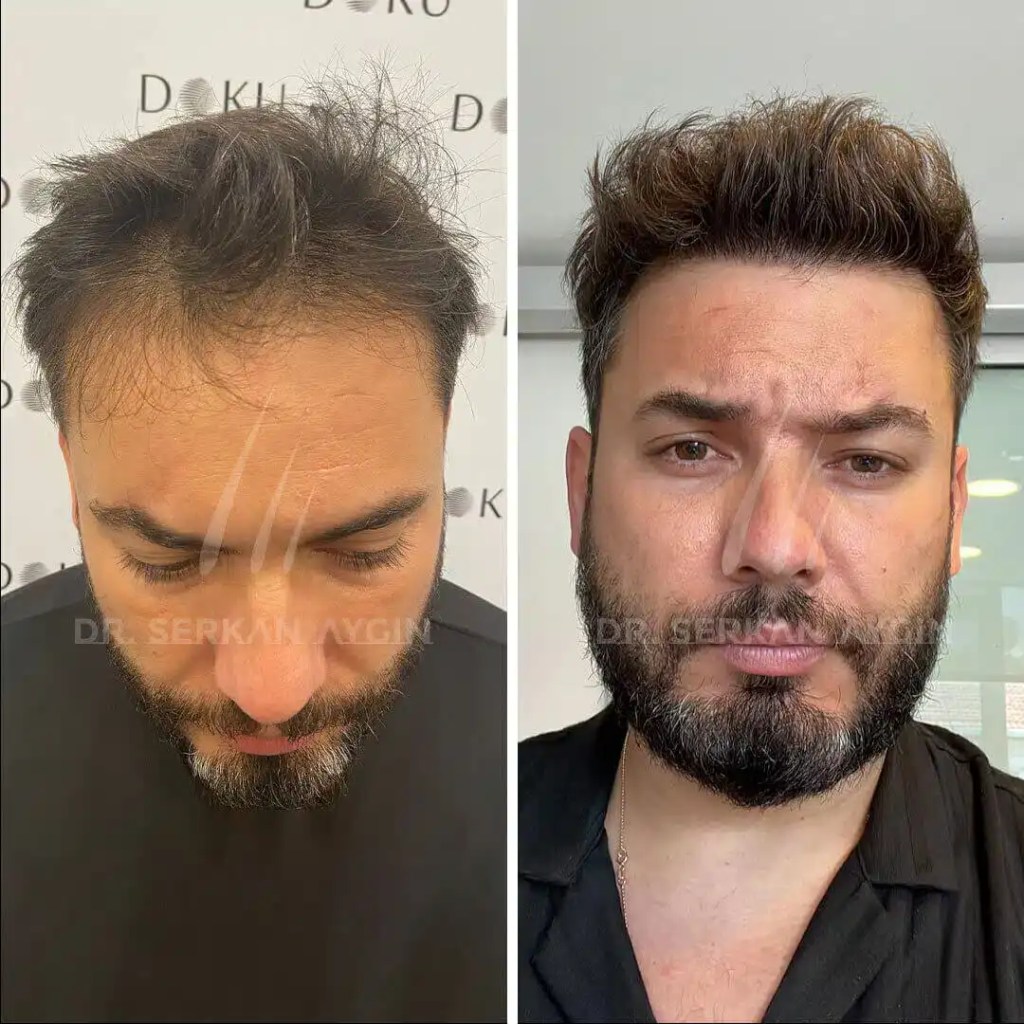 Avant et après greffe capillaire à la clinique du Dr Serkan à Istanbul montrant une repousse dense et naturelle des cheveux