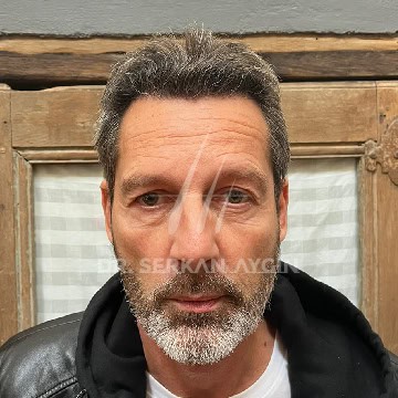 Résultat après greffe capillaire à la clinique du Dr Serkan à Istanbul présentant une chevelure dense et naturelle