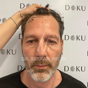 Photo avant greffe capillaire à la clinique du Dr Serkan à Istanbul montrant les zones dégarnies à traiter