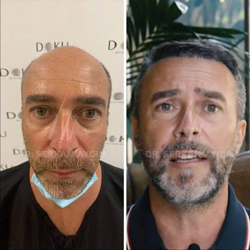 Résultat avant et après d’une greffe capillaire réalisée à la clinique du Dr Serkan à Istanbul montrant une densité capillaire naturelle