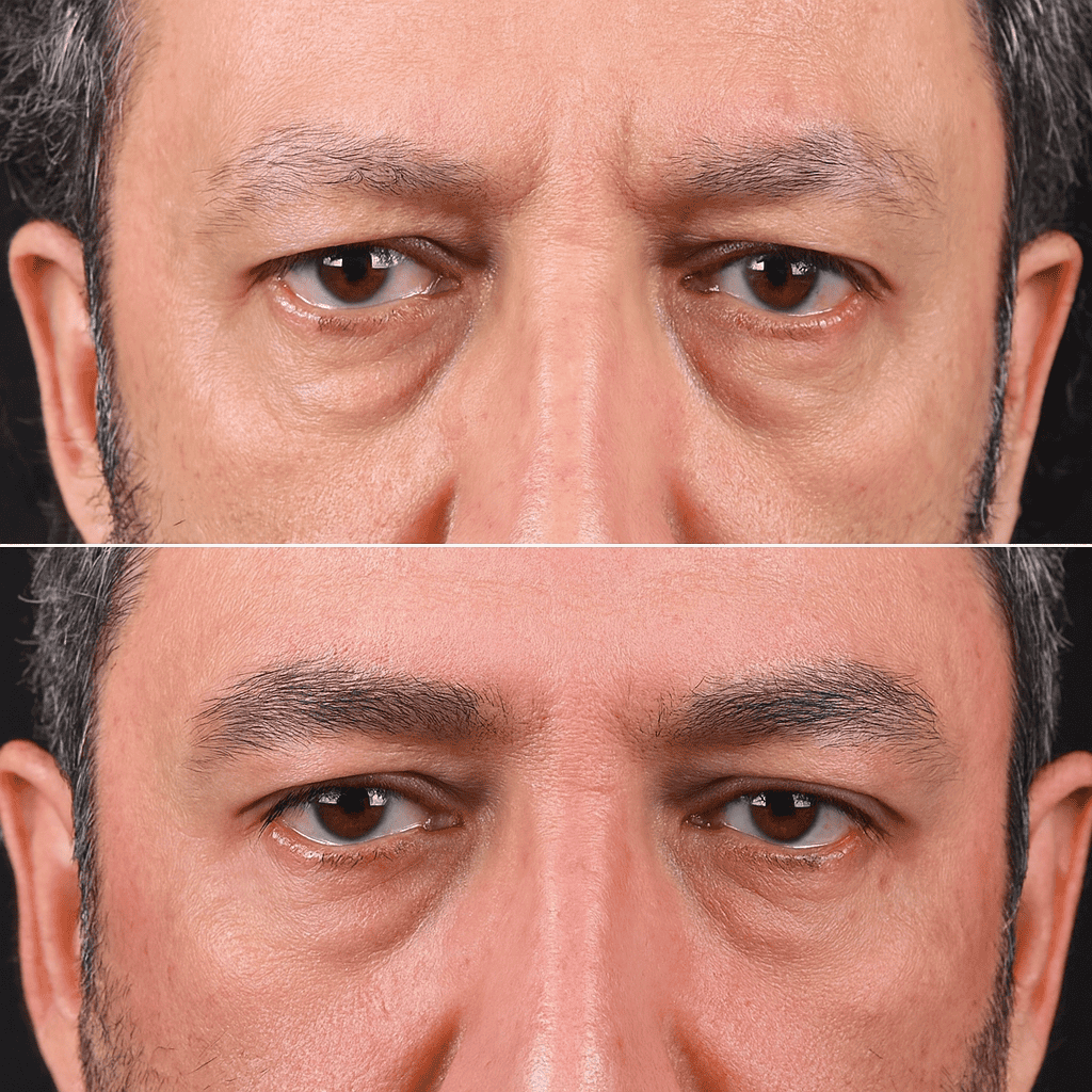 Risultato prima e dopo trapianto sopracciglia uomo: correzione diradamento e definizione dell'arcata sopraccigliare.