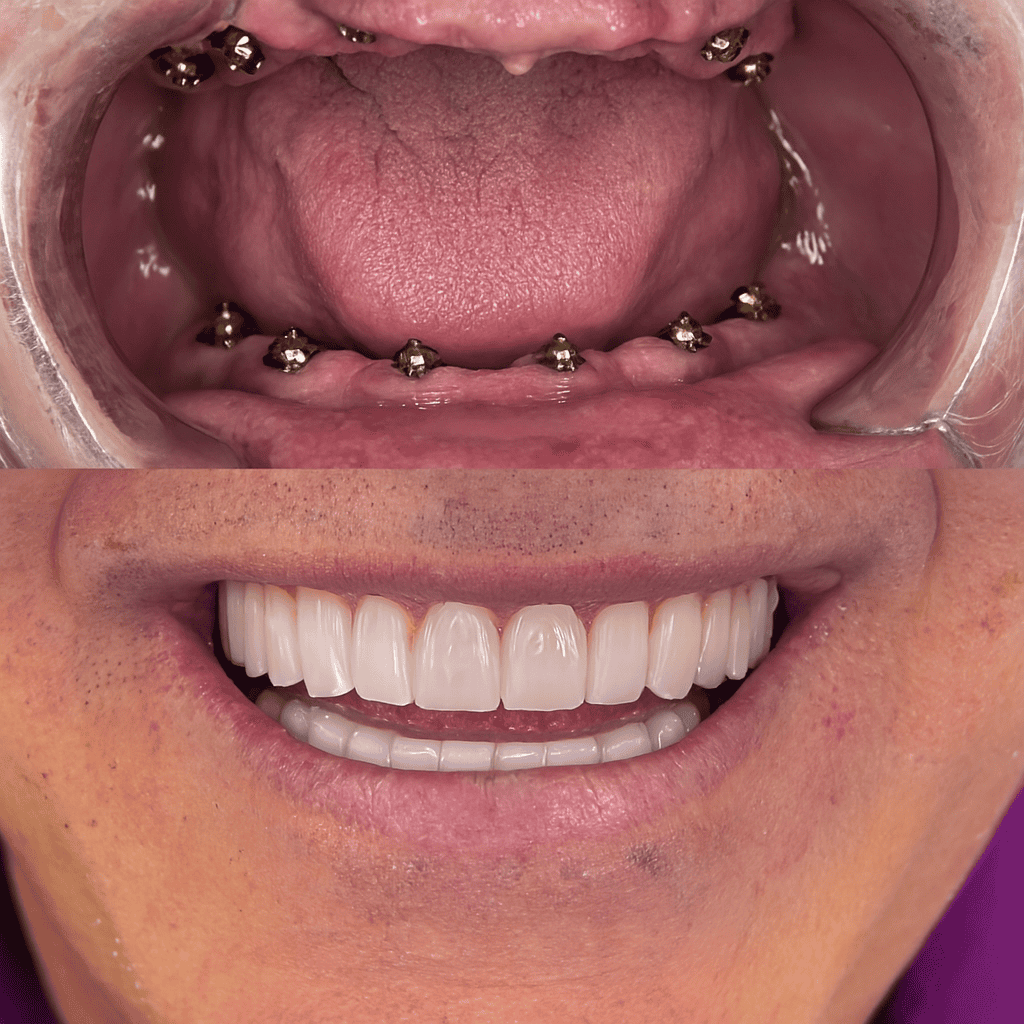 Avant et après traitement All-on-Six montrant la pose d’implants dentaires complets avec un sourire restauré et naturel
