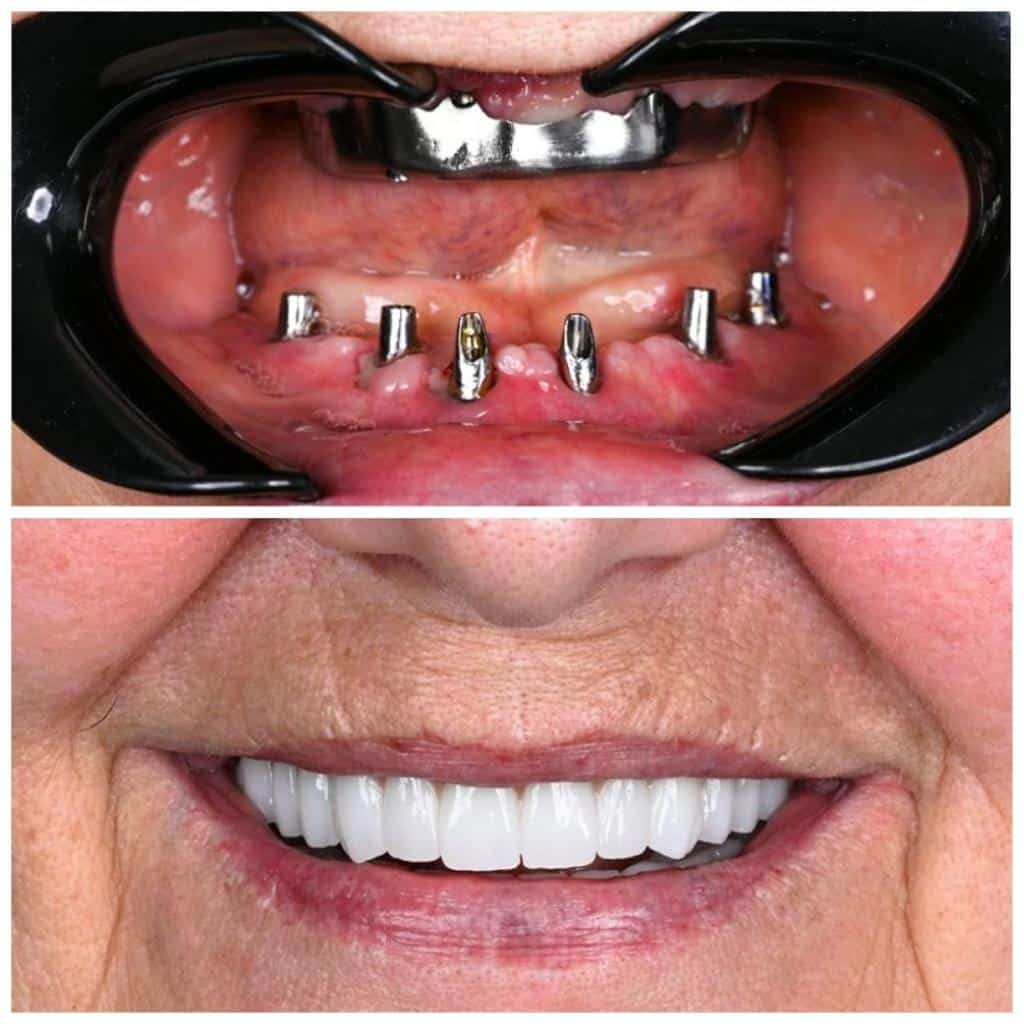 Avant et après pose d’implants dentaires All-on-Six montrant la reconstruction complète de la mâchoire et un sourire esthétique naturel