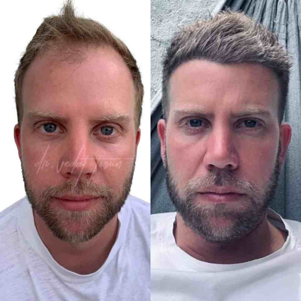 Résultat avant et après une greffe de cheveux réalisée au Liv Hospital en Turquie