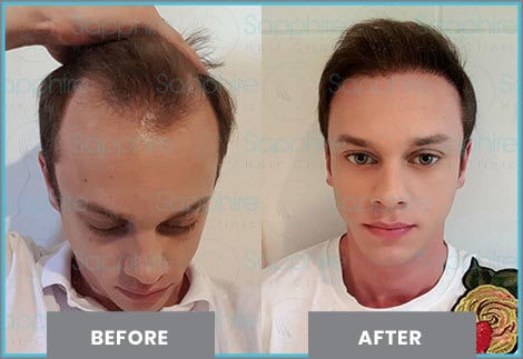 Perte de cheveux avant et après traitement capillaire, résultat naturel, clinique de renom en Turquie.