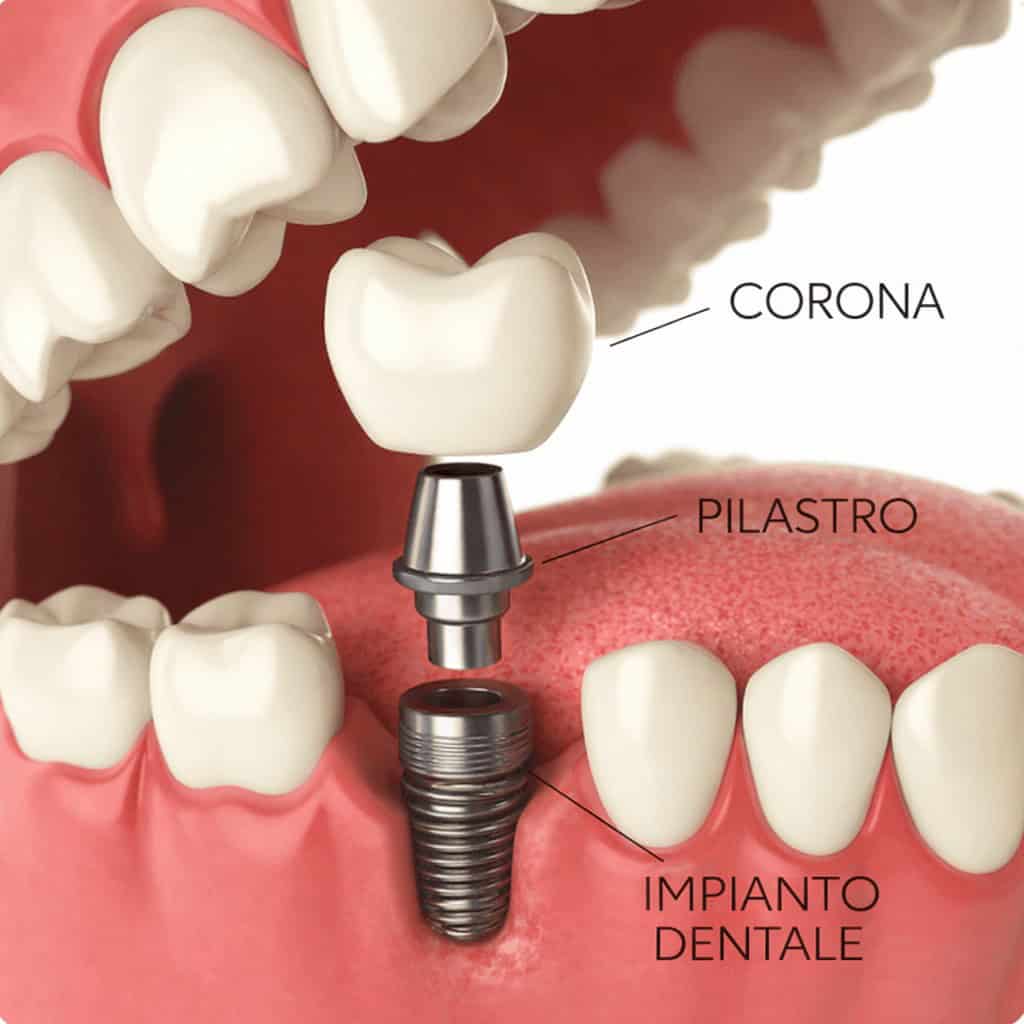 Illustrazione 3D di un impianto dentale con corona, pilastro e vite implantare inserita nell’osso mascellare, spiegazione delle componenti dell’impianto dentale in Turchia