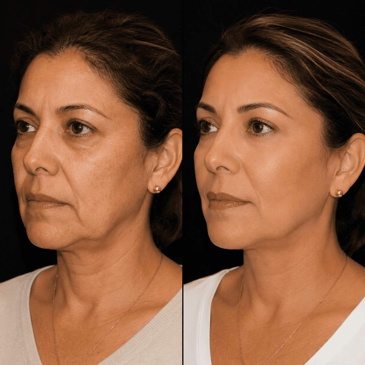 Résultats avant après lifting visage Avant après d'un lifting cervico-facial en Turquie avec amélioration de l'ovale du visage et du cou.