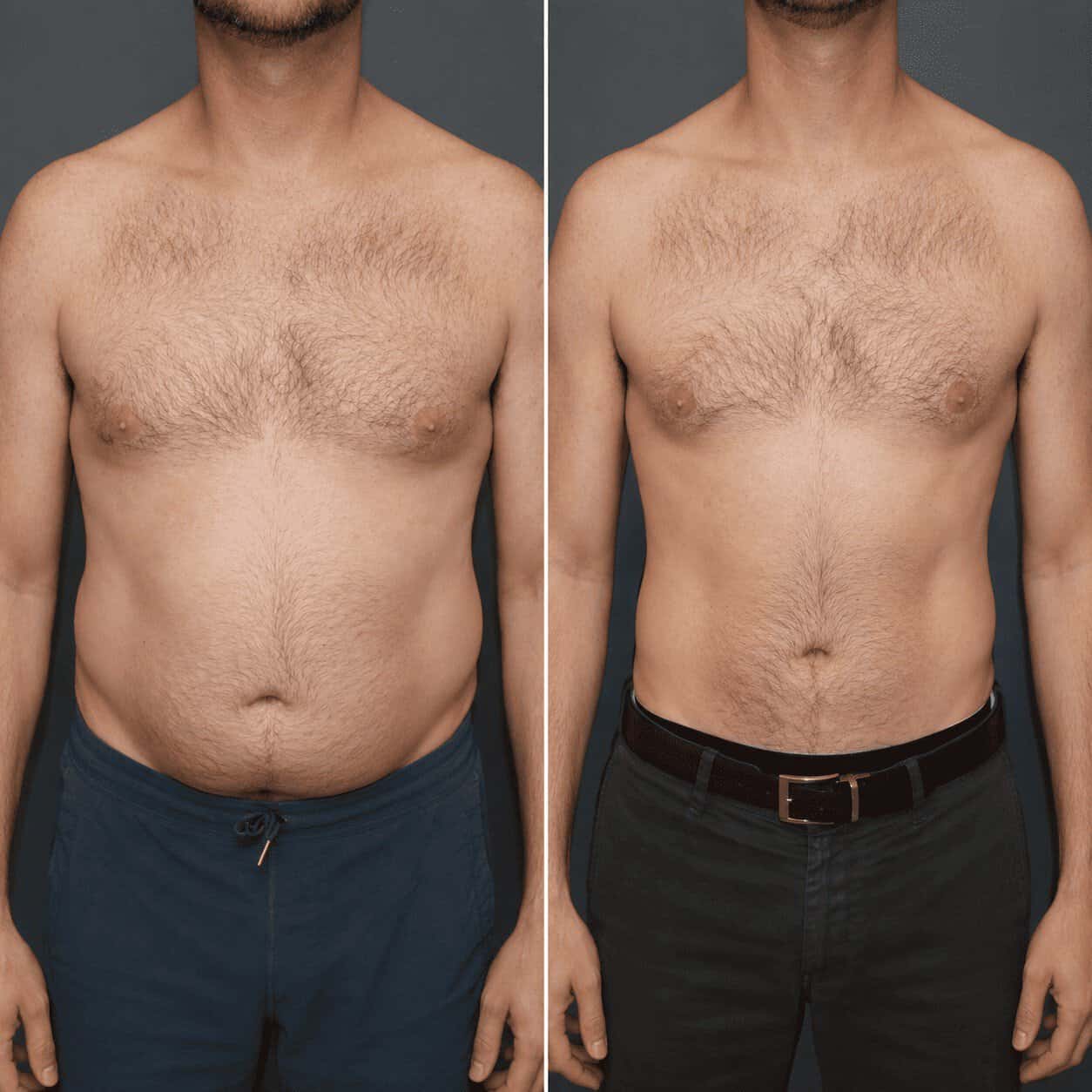 Comparatif avant après d'une liposuccion de l'abdomen chez un homme en Turquie montrant une réduction des amas graisseux et une silhouette plus harmonieuse.