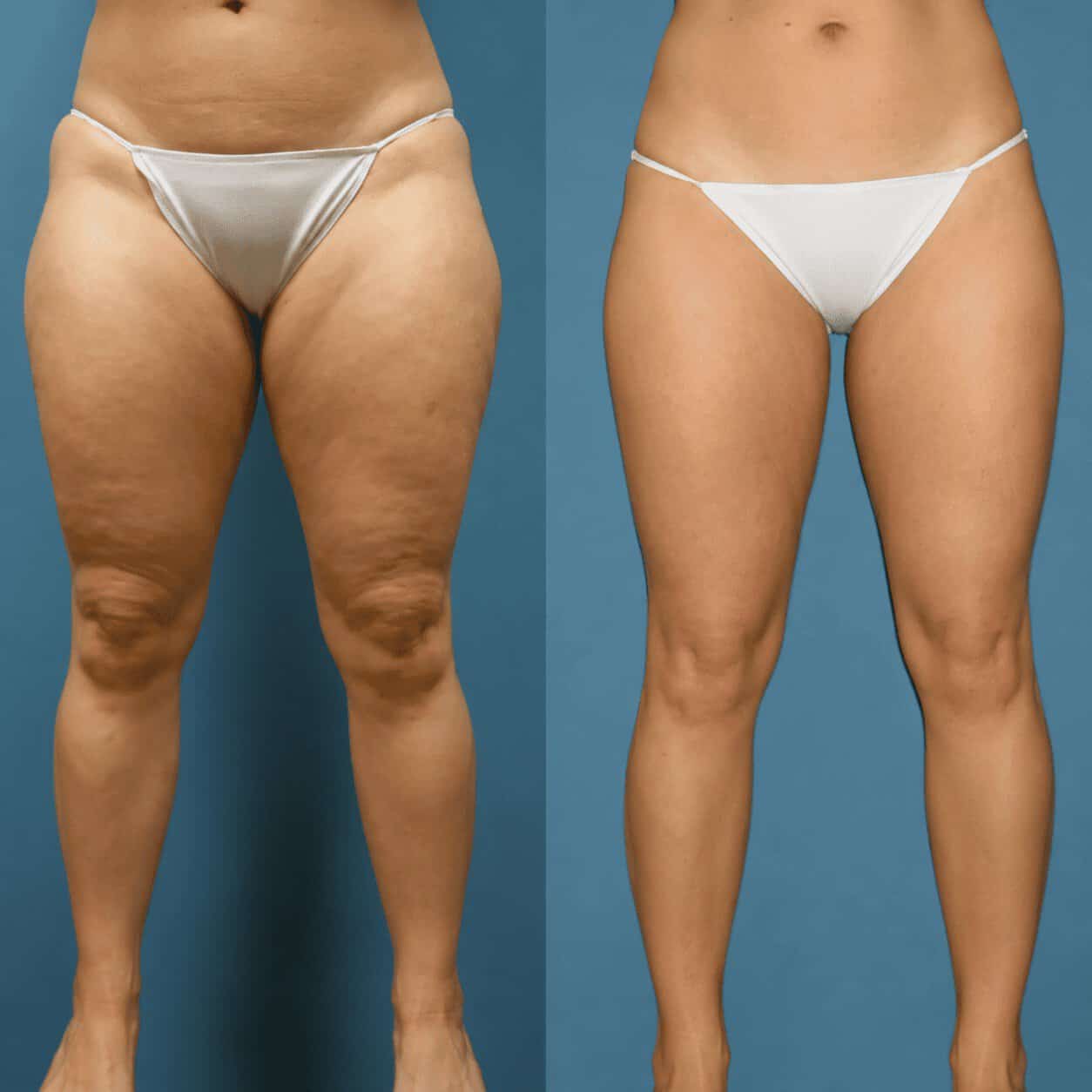 Comparatif avant après d'une liposuccion des cuisses chez une femme en Turquie montrant une réduction de la graisse localisée et des jambes plus harmonieuses.