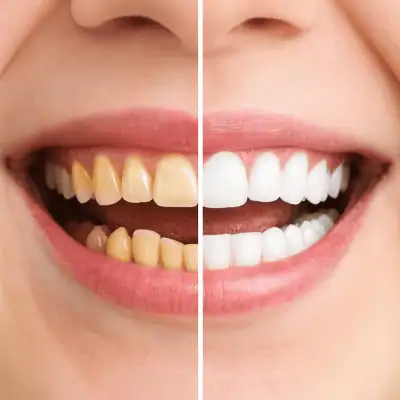 Confronto prima e dopo di un trattamento estetica del sorriso in Turchia.